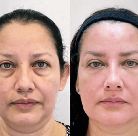 Harmonização facial